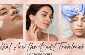 What Are the Best Treatments for Acne Scars?