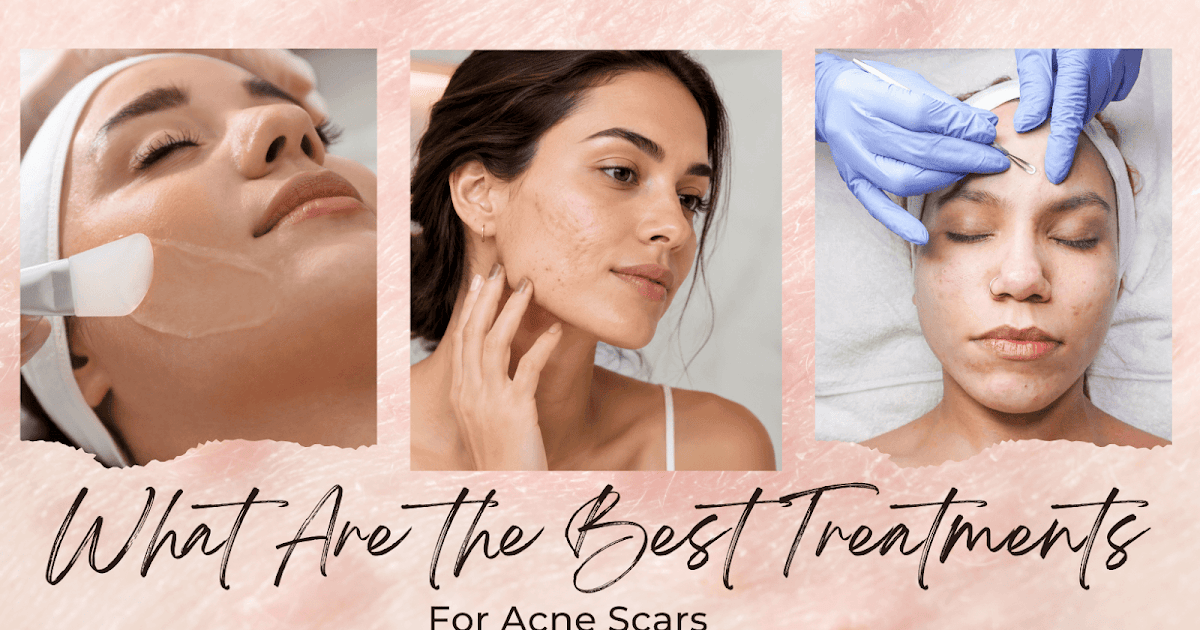 What Are the Best Treatments for Acne Scars?
